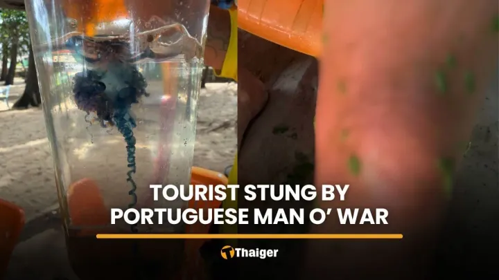 Foreign tourist hospitalised after Portuguese man o’ war sting at Phuket beach | Thaiger